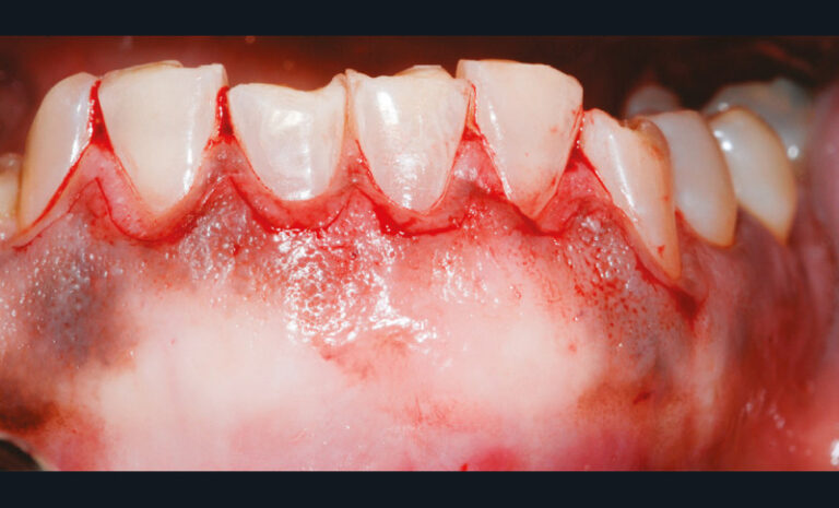 5a. Incisions sous-marginales en présence de gencive kératinisée abondante suivie d’une gingivectomie laissant un bandeau suffisant de gencive kératinisée.