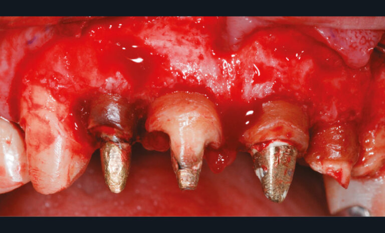 4b. Gingivectomie associée à une ostectomie circonférentielle de 3 à 5 mm afin de recréer l’espace de l’attache supra-crestale et de la structure dentaire disponible pour la rétention prothétique.
