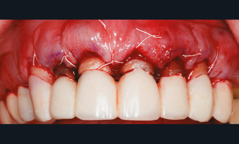 4c. Lambeau repositionné et suturé en fin d’intervention. Le bridge provisoire est rescellé. 2 mm de dentine saine émergent de la gencive marginale pour le futur sertissage prothétique.