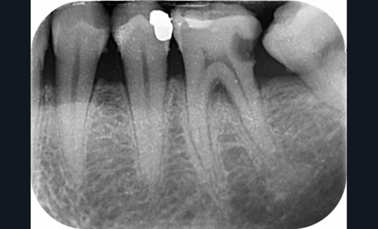 5 et 6. Radiographie bite-wing de contrôle d’un patient après l’extraction non compensée d’une deuxième molaire et radiographie 3 ans plus tard objectivant une carie profonde (vu en urgence pour une pulpite de la première molaire).