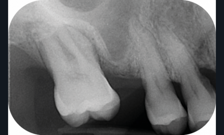 7, 8, 9. Photographies et radiographie de la version dentaire d’une seconde molaire à la suite de la non-compensation de l’extraction de la première, une atteinte parodontale terminale a entrainé l’avulsion de la seconde molaire.