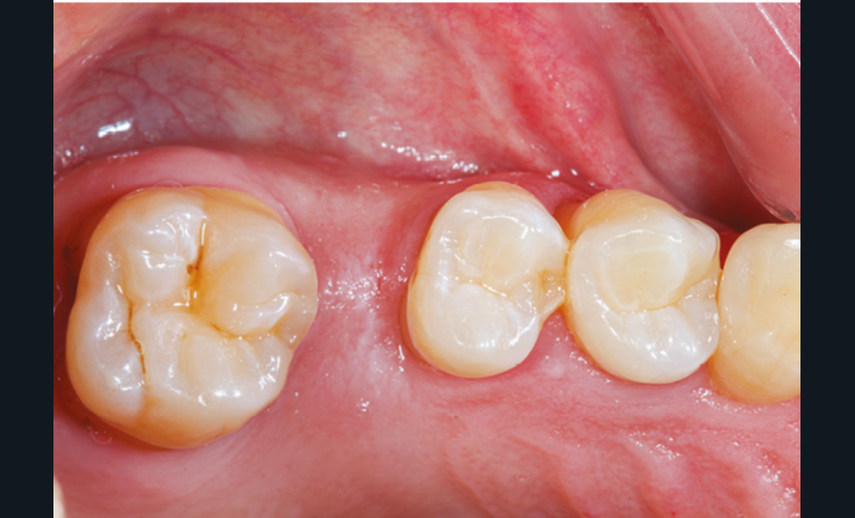 7, 8, 9. Photographies et radiographie de la version dentaire d’une seconde molaire à la suite de la non-compensation de l’extraction de la première, une atteinte parodontale terminale a entrainé l’avulsion de la seconde molaire.