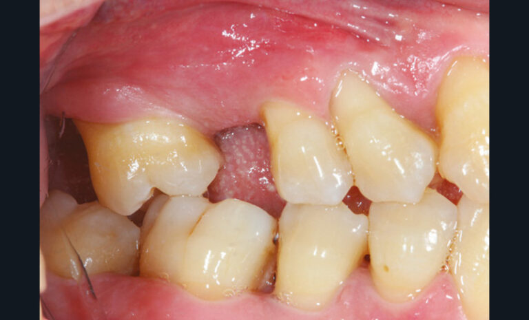 7, 8, 9. Photographies et radiographie de la version dentaire d’une seconde molaire à la suite de la non-compensation de l’extraction de la première, une atteinte parodontale terminale a entrainé l’avulsion de la seconde molaire.