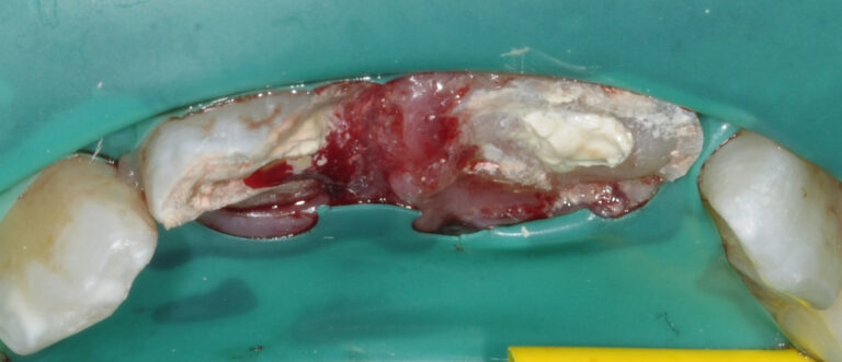 5. Biocéramique (Biodentine™, Septodont) au contact de la pulpe de 11 et 21 suite à une pulpotomie partielle effectuée sur la 11.