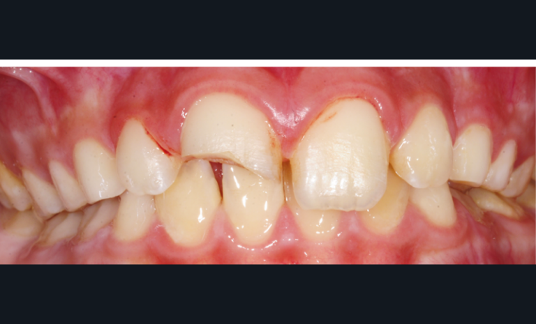 1. Situation initiale endo-buccale une heure après traumatisme objectivant la fracture amélo-dentinaire de la 11.