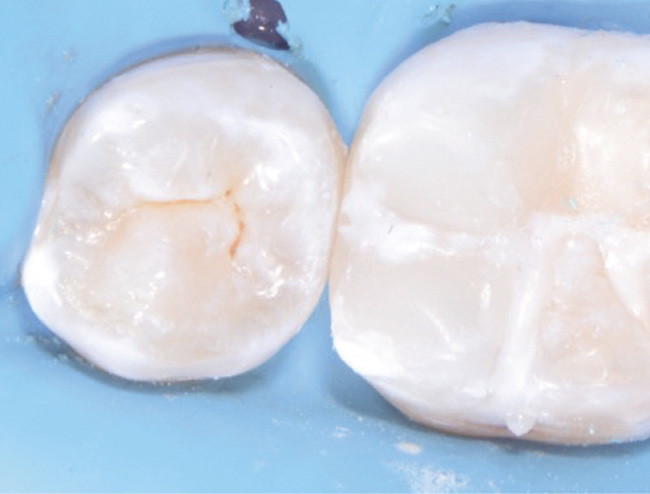 Fig. 4a-c - Restauration coronaire d’usage réalisée immédiatement après le coiffage de la pulpe. Après matriçage et restauration de la face mésiale, la cavité est restaurée au composite par méthode directe. Cette procédure permet d’obtenir une étanchéité immédiate de la restauration qui vient compléter l’étanchéité du biomatériau de coiffage.