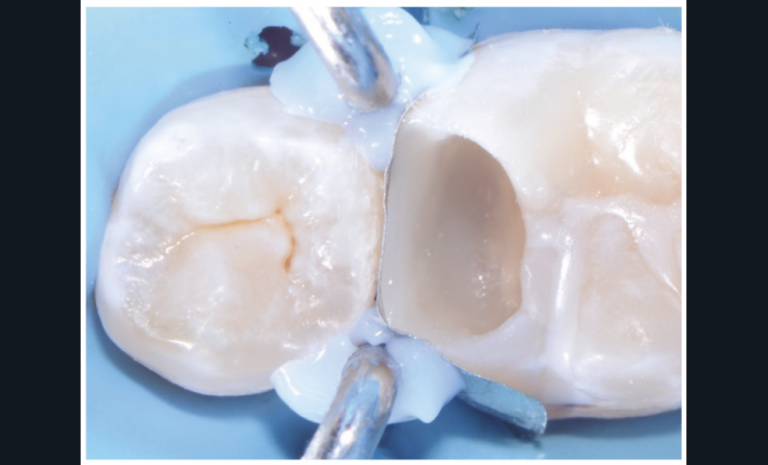 Fig. 4a-c - Restauration coronaire d’usage réalisée immédiatement après le coiffage de la pulpe. Après matriçage et restauration de la face mésiale, la cavité est restaurée au composite par méthode directe. Cette procédure permet d’obtenir une étanchéité immédiate de la restauration qui vient compléter l’étanchéité du biomatériau de coiffage.