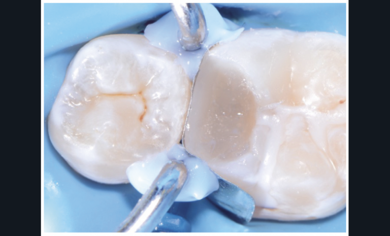 Fig. 4a-c - Restauration coronaire d’usage réalisée immédiatement après le coiffage de la pulpe. Après matriçage et restauration de la face mésiale, la cavité est restaurée au composite par méthode directe. Cette procédure permet d’obtenir une étanchéité immédiate de la restauration qui vient compléter l’étanchéité du biomatériau de coiffage.