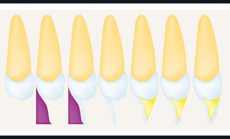 17 et 18. Schéma didactique des étapes de la stratification naturelle. De gauche à droite : - situation initiale ; - mise en place de la clé en silicone pour s’assurer de son bon positionnement ; - réalisation du mur palatin de la restauration avec du composite émail ; - retrait de la clé en silicone ; - recréation des lobes de dentine par une masse dentine appliquée sur le mur palatin ; - ajout de masses effets pour caractériser une dent ; - recouvrement total par la masse émail sélectionnée des lobes dentinaires préalablement reconstitués.