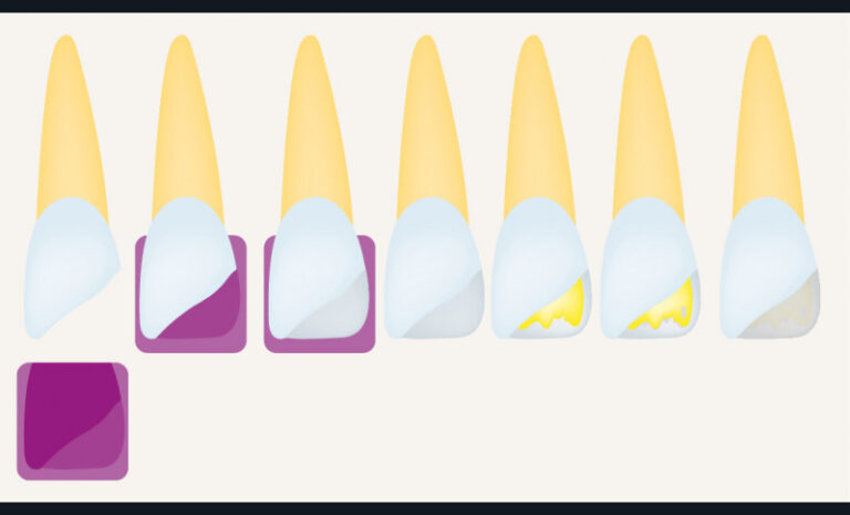 17 et 18. Schéma didactique des étapes de la stratification naturelle. De gauche à droite : - situation initiale ; - mise en place de la clé en silicone pour s’assurer de son bon positionnement ; - réalisation du mur palatin de la restauration avec du composite émail ; - retrait de la clé en silicone ; - recréation des lobes de dentine par une masse dentine appliquée sur le mur palatin ; - ajout de masses effets pour caractériser une dent ; - recouvrement total par la masse émail sélectionnée des lobes dentinaires préalablement reconstitués.