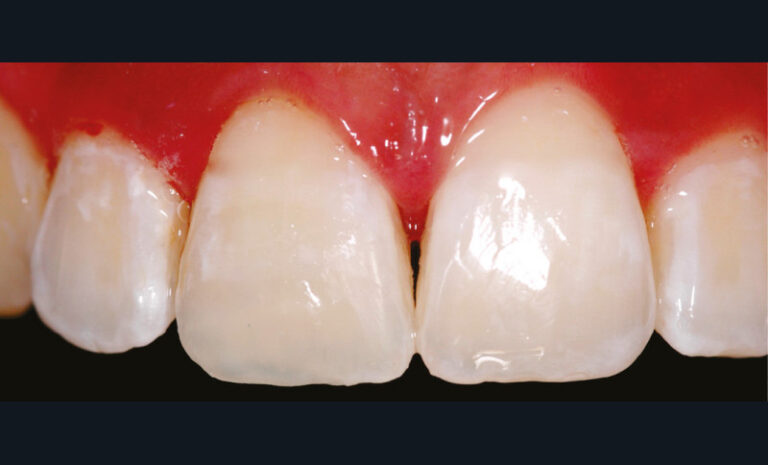 13. Vue de la restauration après dépose du champ opératoire (restauration réalisée avec le composite Miris® 2).