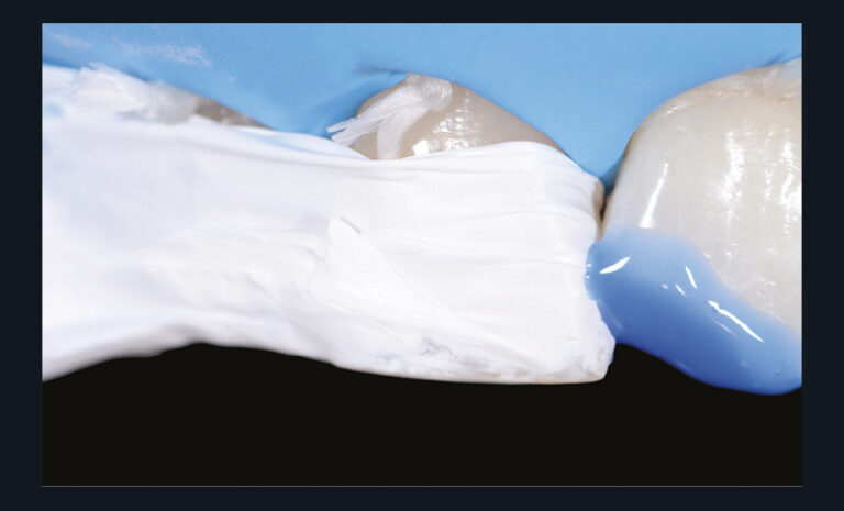 23. Conditionnement des tissus dentaires avec un gel d’acide phosphorique.