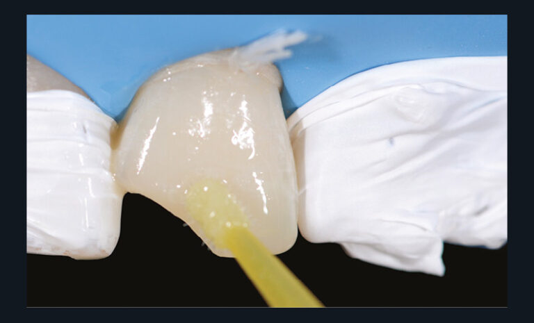 24. Application de la résine adhésive sur la préparation dentaire.