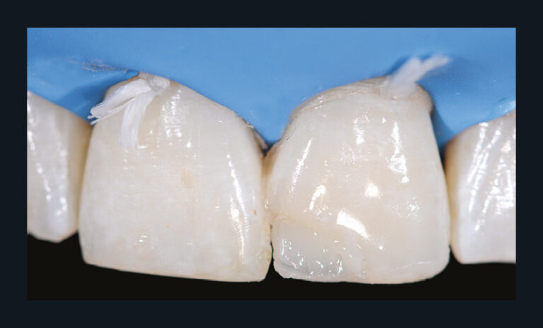 27. Application de la masse dentine.