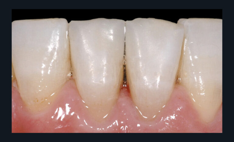 5. Vue postopératoire après dépose du champ opératoire (restaurations réalisées avec le composite Enamel HRI®, Micerium Bisico).