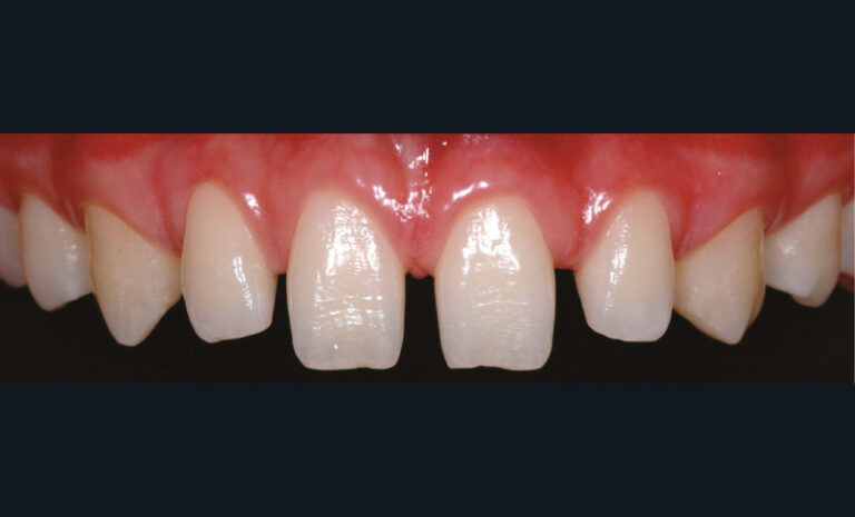 8. Situation initiale. Cet adolescent présente des diastèmes qu’il souhaiterait fermer. Un traitement orthodontique n’a pas d’intérêt. En effet, le sujet est en classe 1 molaire et canine. Les diastèmes sont en relation avec une microdontie relative provoquant cette dysharmonie dento-maxillaire.