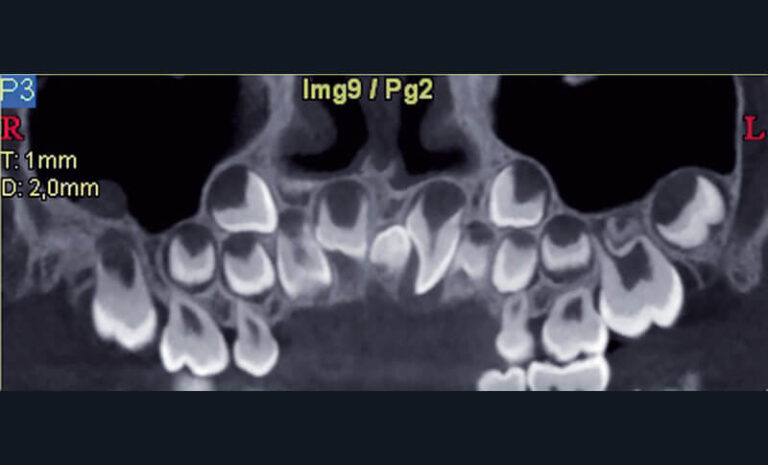 Fig. 10 
a) Cas clinique 3. Reconstruction curviligne de type panoramique identifiant un odontome de type mesiodens entre 11 et 21 (appareil CBCT NewTom® 5g, Quantitative Radiology®) chez un enfant de 6 ans.