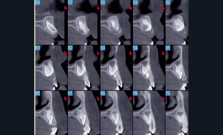 b) Reconstructions coronales identifiant la position du mesiodens par rapport aux incisives centrales maxillaires 11 et 21 (appareil CBCT NewTom® 5g, Quantitative Radiology®).