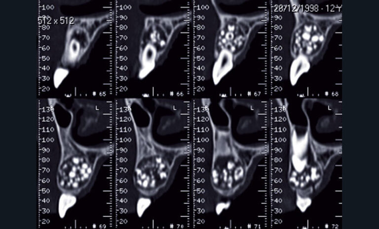 Fig. 11 
a) Cas clinique 4. Reconstructions coronales identifiant la présence d’un odontome complexe dans la région maxillaire antérieure chez une adolescente de 12 ans (Dentascanner, appareil de tomodensitométrie GE HealthCare®).