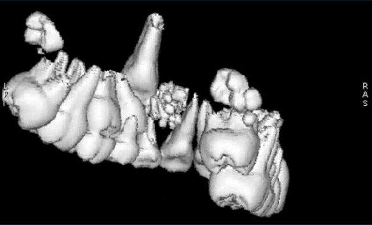 b) Vue postérieure d’une reconstruction 3D avec seuillage permettant d’extraire de l’image tous les tissus hormis les tissus dentaires (appareil de tomodensitométrie GE HealthCare®).