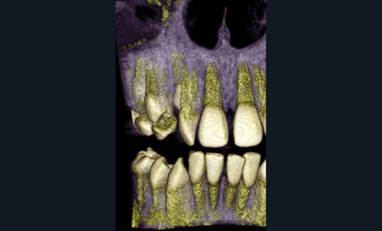 Fig. 12 - Reconstruction 3D (appareil CBCT, White Fox, Acteon®) montrant le positionnement d’une canine maxillaire (13) chez un enfant de 11 ans.