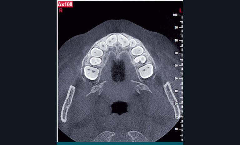 Fig.13 
a) Cas clinique 5. Reconstruction axiale identifiant 2 incisives permanentes maxillaires avec des morphologies coronaires (fusions de 11 et 12, et de 21 et 22) et canalaires (2 canaux parfaitement individualisés) atypiques chez un enfant de 5 ans (NewTom® 5g, Quantitative Radiology®).