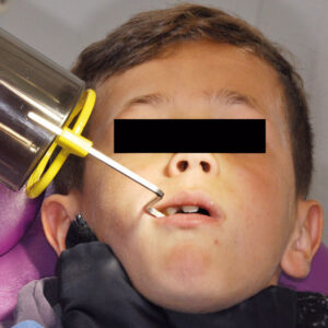 Fig. 4 - Cliché rétro-alvéolaire maxillaire de la dent 55 avec angulateur de Rinn chez un patient de 7 ans. La thyroïde est recouverte d’un protège- thyroïde.