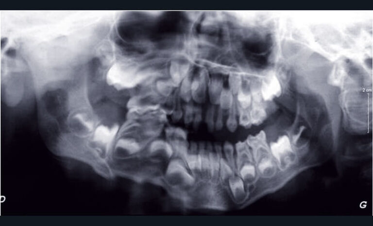 Fig. 5 - Orthopantomogramme de mauvaise qualité d’un enfant de 4 ans en raison d’un déficit de coopération lors de la réalisation.