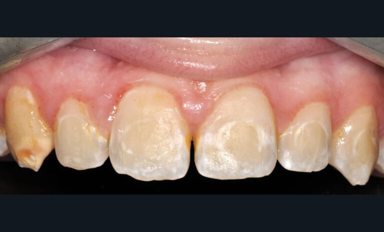 Fig. 9 - Déminéralisations amélaires à la suite d’un traitement orthodontique chez un adolescent avec une mauvaise hygiène bucco-dentaire