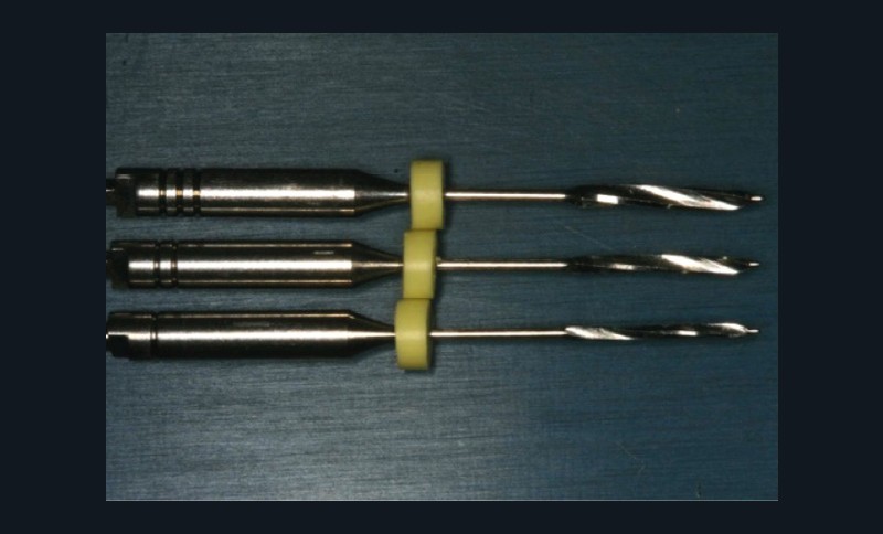 5. Détermination de la longueur de préparation intracanalaire et vérification de cette longueur par cliché rétro-alvéolaire.