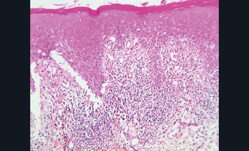 Vue histologique (GX20) d’une réaction lichénoïde montrant un infiltrat lympho-plasmocytaire en bande sous la membrane basale avec décollement épidermique supra basal et kératose de surface (b).