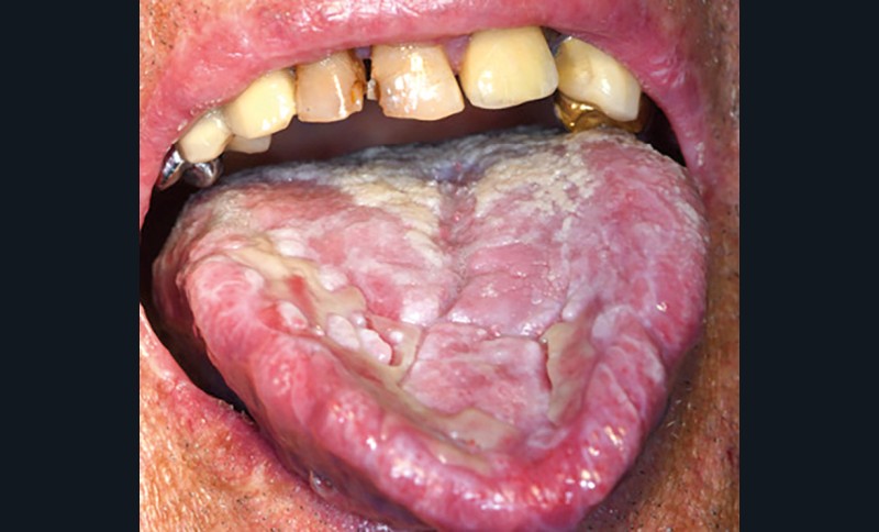 3. LLOIM induite par un traitement en cours par inhibiteur de point de contrôle immunitaire (nivolumab) (a), par un traitement en cours par anti-TNF (infliximab), un traitement par des sels d’or arrêtés il y a vingt ans (c).