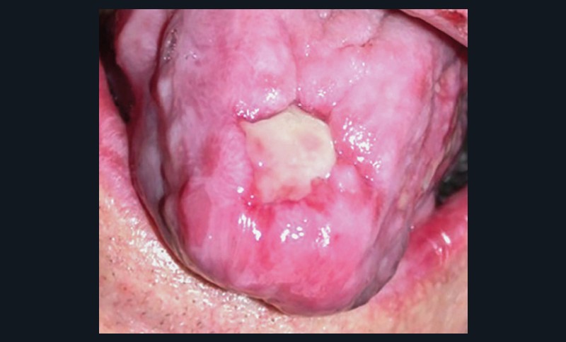 5. Lésions lichénoïdes buccales, conjonctivales et cutanés dans un syndrome de Good.