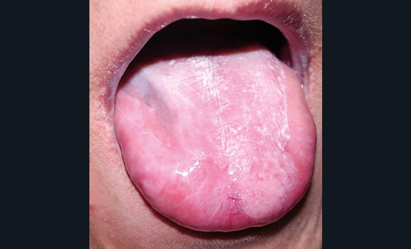 7. Lésions lichénoïdes induites par une candidose chronique sur terrains immunodéprimés dans un syndrome APECED (a) et dans une mutation génétique de STAT1 (b).
