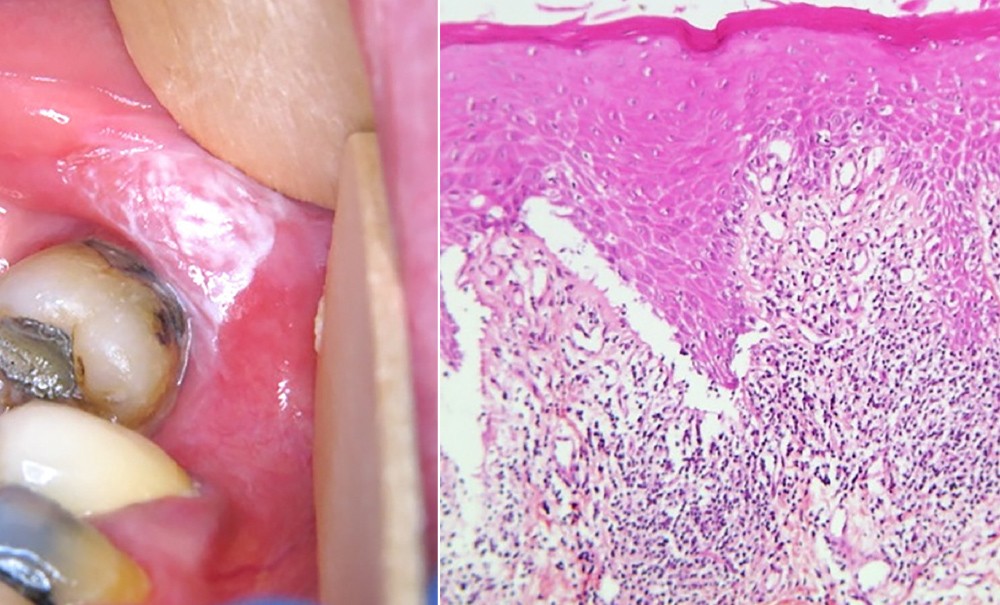 lesions-lichenoides-orales-induites-tt-width-1000-height-605-max_height-800-crop-1-bgcolor-f0f2f7-isLogoPro