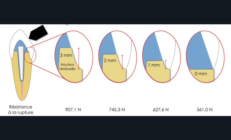 1. Résistance à la fracture en fonction de la hauteur du cerclage cervical.