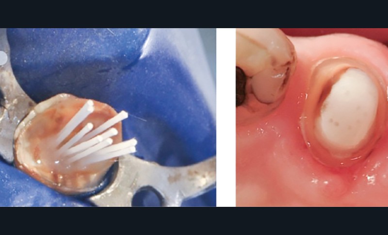 4. Tenons fasciculés (multi-tenons fibrés) utilisés lors d’une RMIPP.