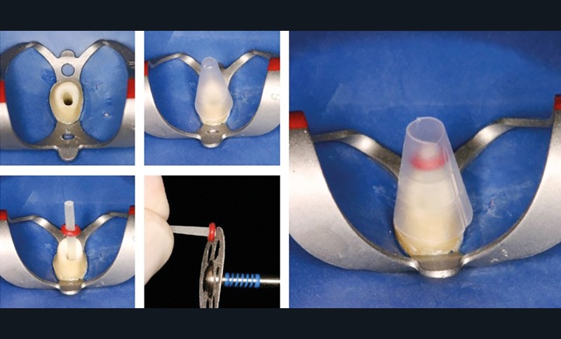6. Sélection et adaptation en longueur du tenon fibré et de la matrice.