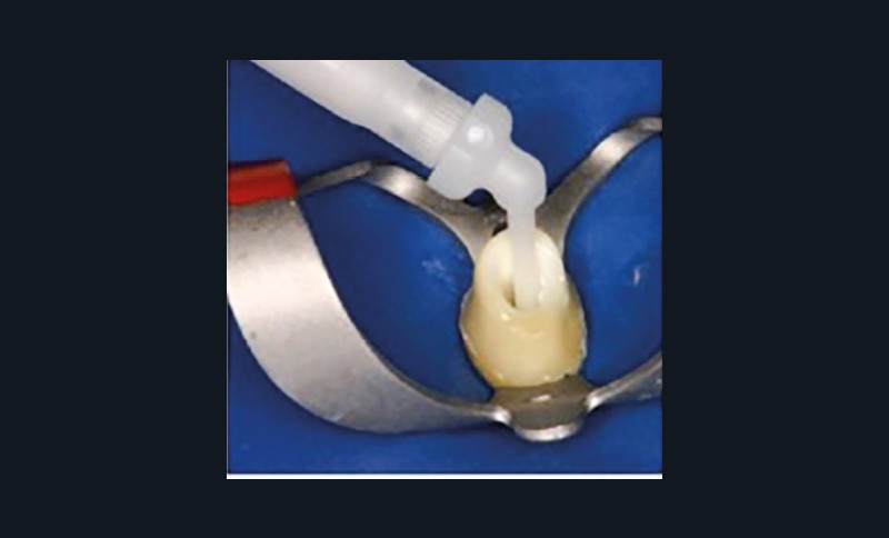 8. Sélection et adaptation en longueur du tenon fibré et de la matrice.
