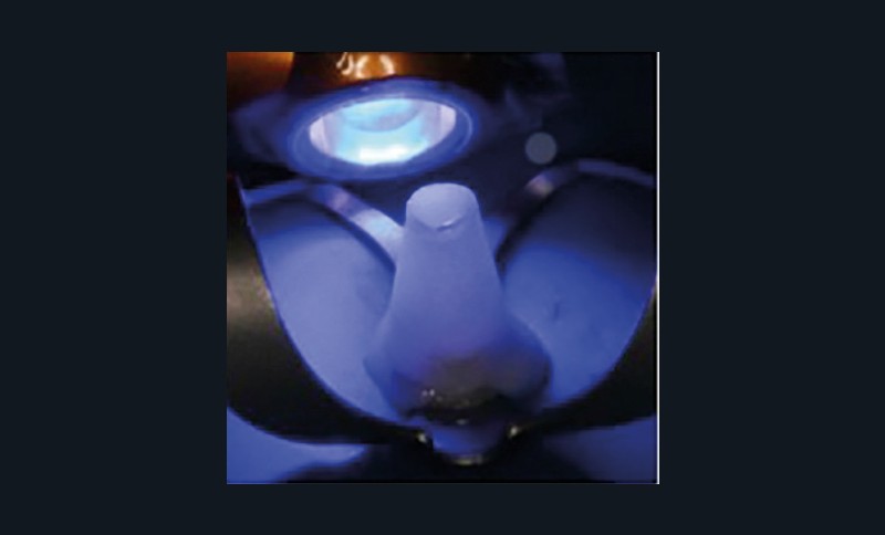 9. Injection intra-canalaire de la résine composite puis photo-polymérisation.