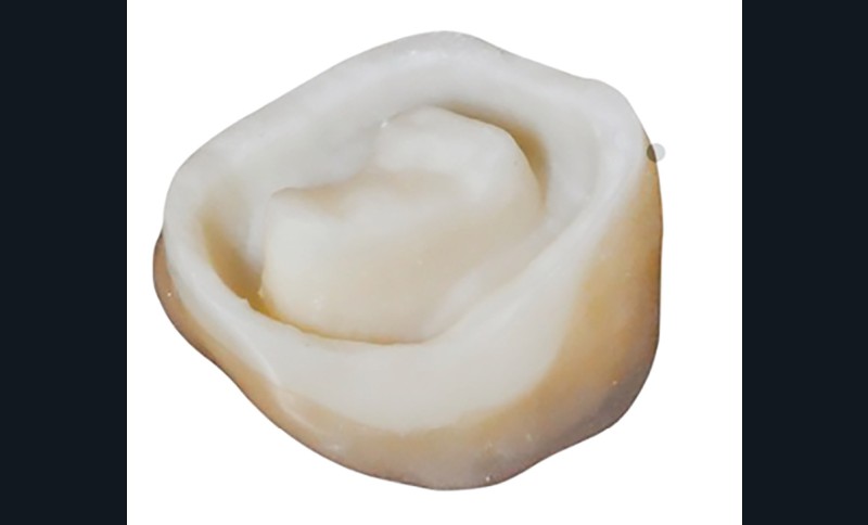 10. Endo-couronne en céramique exploitant la rétention de la partie camérale.