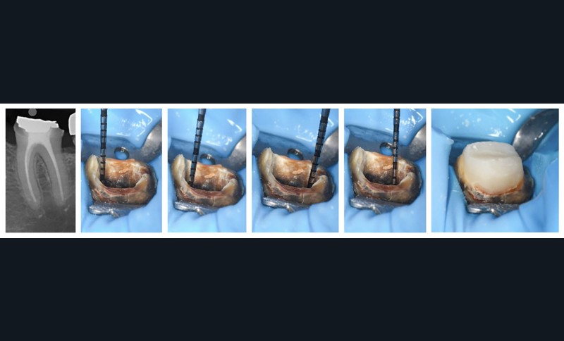 11. Composite core dont la mise en place est permise par une hauteur camérale suffisante de 4 mm sur 75 % de la périphérie coronaire.