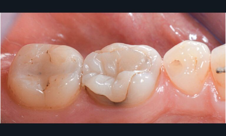 1. Photo illustrant la dégradation de joint collé au niveau de restaurations directes en composite (37 et 35) et au niveau d’un onlay (36).