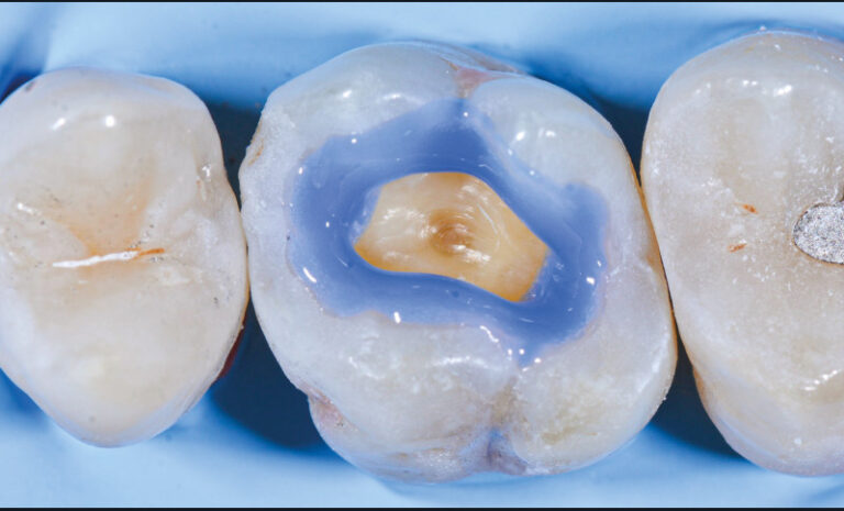 9. Le mordançage sélectif à l’acide phosphorique uniquement sur l’émail sans mordançage de la dentine permet une moindre dégradation du joint collé dans le temps.