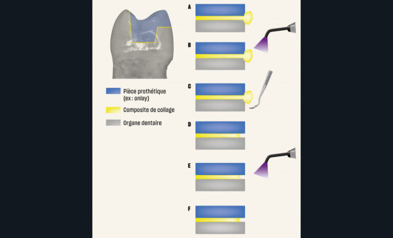 11. Importance du mode de polymérisation sur la qualité et la pérennité du joint collé. La polymérisation flash souvent préconisée par les fabricants induit une mauvaise qualité du joint collé A. Collage d’une pièce prothétique. On observe un excès de composite de collage. B. Polymérisation flash de 2 secondes. C. Élimination facile de l’excès de composite de collage à l’aide d’un instrument. D. On observe que le joint de colle a été arraché car le composite de collage n’est pas assez polymérisé lors du retrait des excès. E. Polymérisation finale du composite et collage. F. Après polymérisation, le joint de colle n’est pas en continuité avec la dent et la restauration.