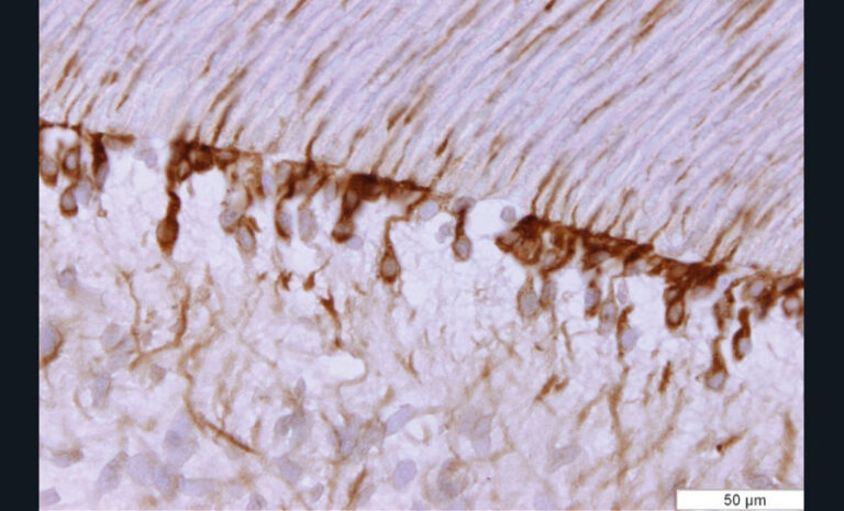 6. Vue de microscopie d’une coupe de dent objectivant une augmentation de l’expression de proMMP-9 (après marquage immunohistochimique à l’aide d’anticorps anti pro-MMP-9) dans le complexe pulpo-dentinaire après application systèmes adhésifs amélo-dentinaires.