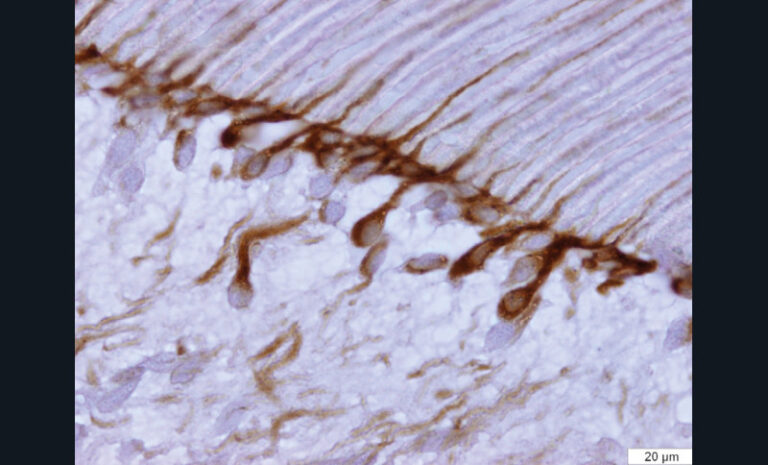 7. Vue de microscopie d’une coupe de dent objectivant une augmentation significative de l’expression de MMP-2 (après marquage immunohistochimique à l’aide d’anticorps anti MMP-2) au sein des odontoblastes après application systèmes adhésifs amélo-dentinaires.