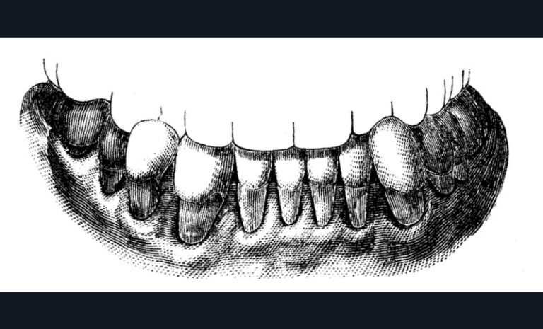 2. Représentation de lésions d’usure dentaire mécanique liées au brossage dentaire (en haut) et chimique liées à la consommation excessive de citron (en bas) par Darby en 1892 [4].