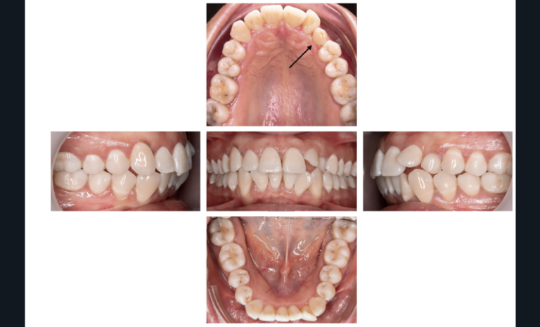 1. Situation endobuccale initiale.