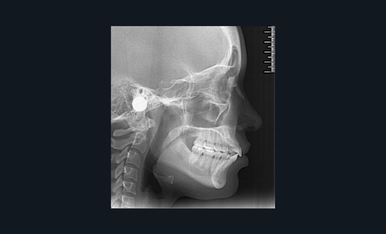 2. Situation radiologique initiale confirmant la biproversion incisive et la canine incluse 23.
